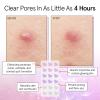 imagegrace ampamp stella Award Winning Acne Device  Pimple Patches for Face  FSA HSA Hydrocolloid Acne Patches  Absorbs Zits Reduces Redness  Cute Patches DermatologistTested Vegan Multishape 36 CountSelfLove 36Pack 