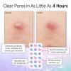 imagegrace ampamp stella Award Winning Acne Device  Pimple Patches for Face  FSA HSA Hydrocolloid Acne Patches  Absorbs Zits Reduces Redness  Cute Patches DermatologistTested Vegan Multishape 36 CountFeelGood 72Pack